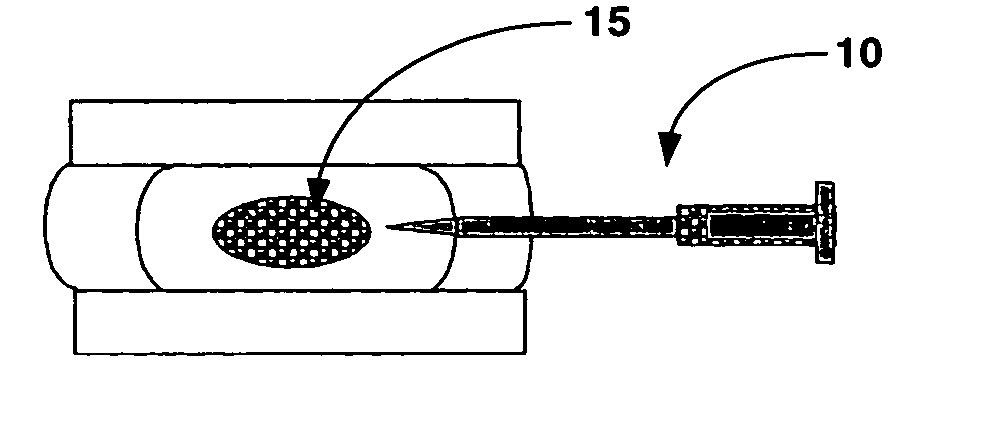 Intervertebral disc augmentation and rehydration with superabsorbent polymers