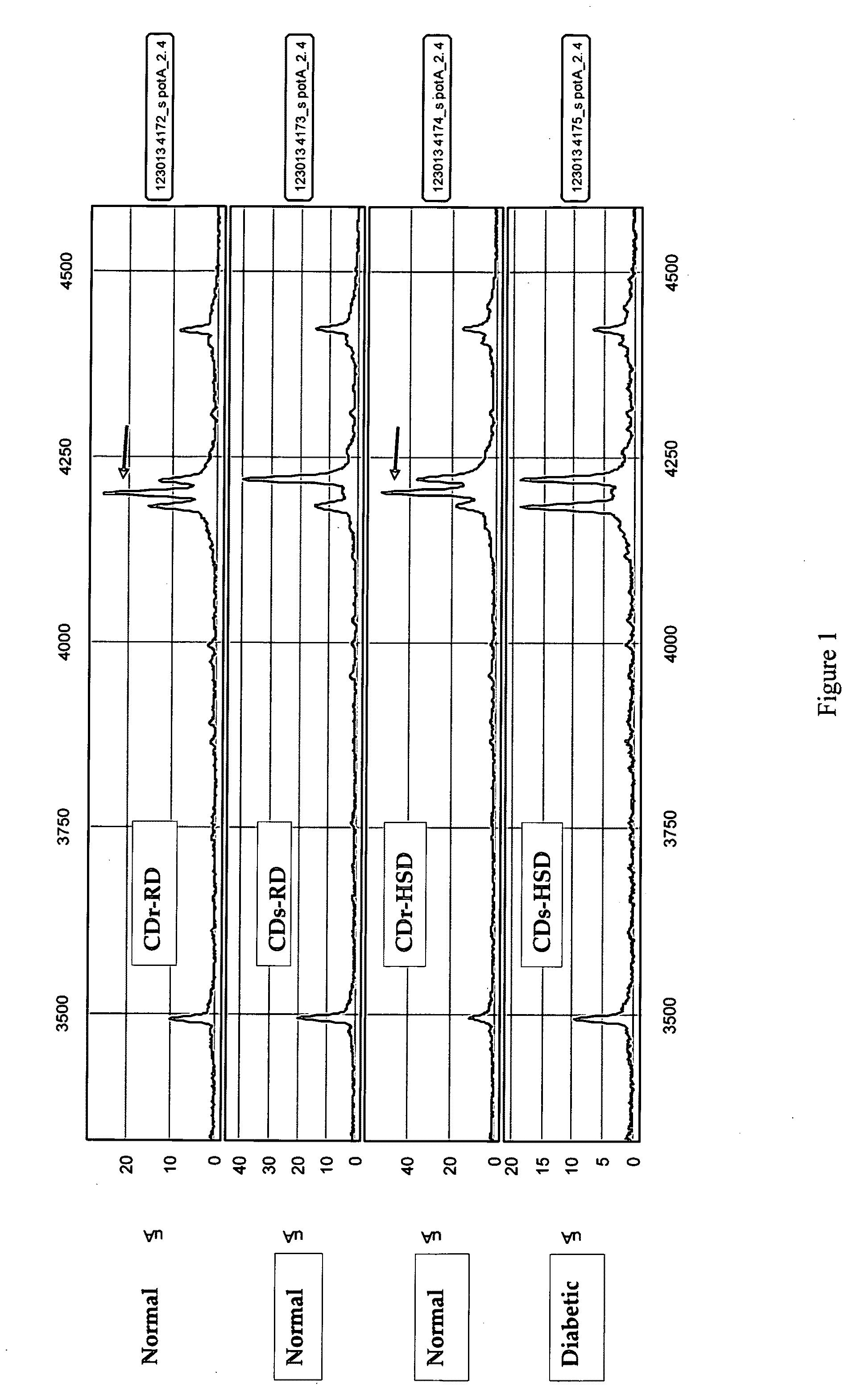 Compositions and methods for diagnosis and treatment of type 2 diabetes