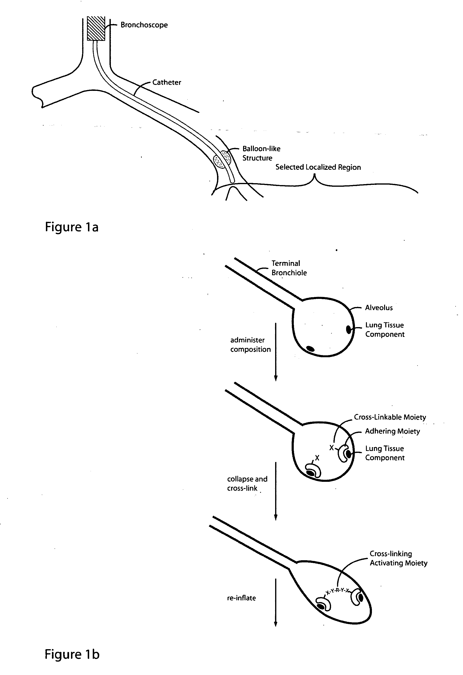 Lung volume reduction using glue composition