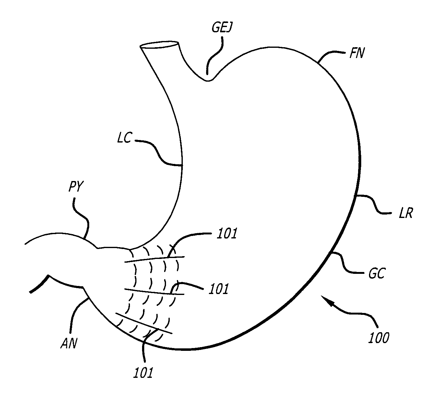 Method and devices for modifying the function of a body organ