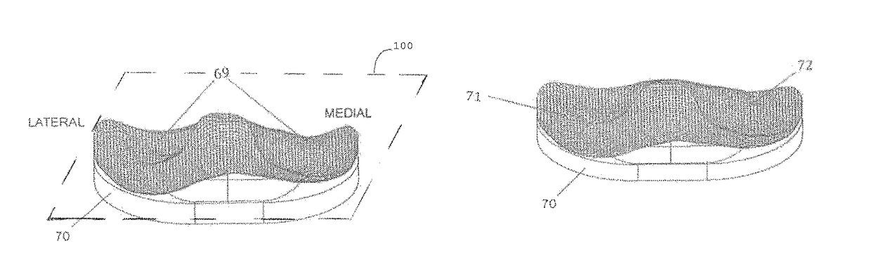 Total knee replacement implant based on normal anatomy and kinematics