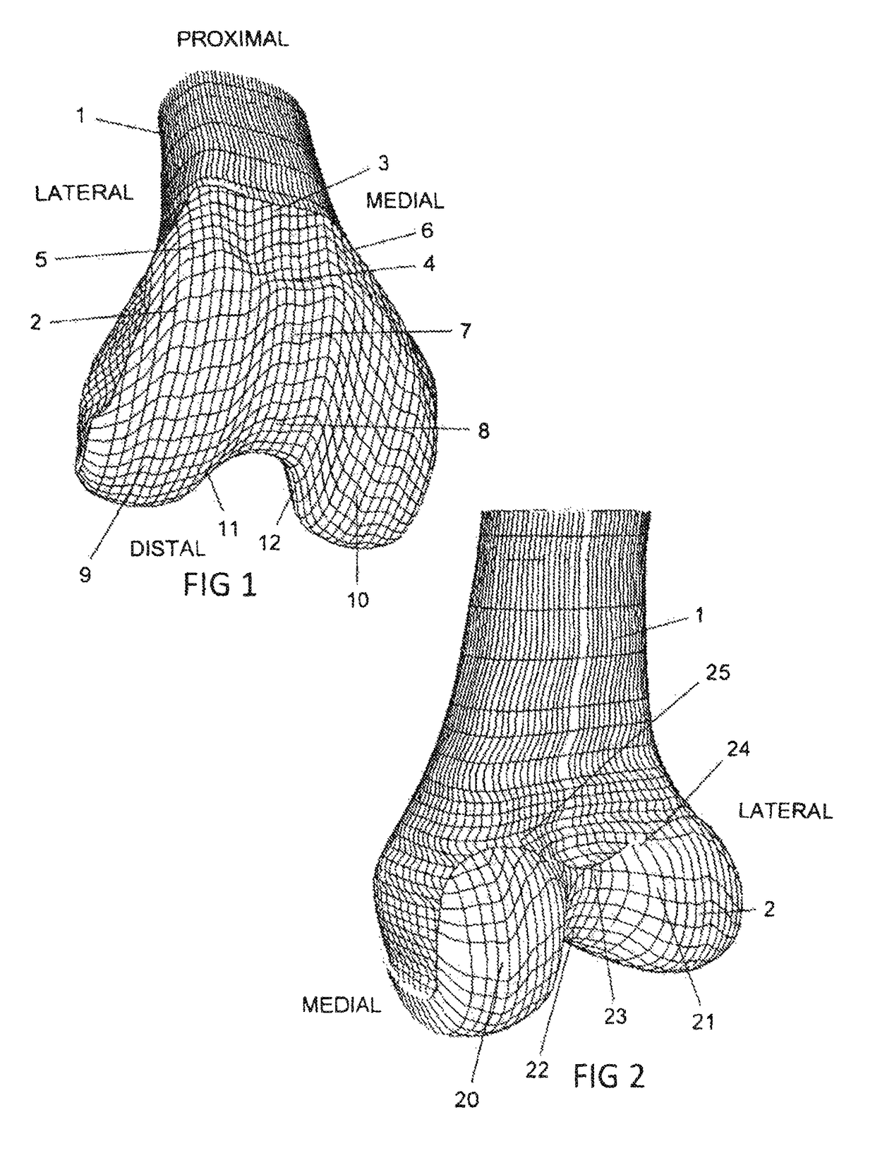 Total knee replacement implant based on normal anatomy and kinematics