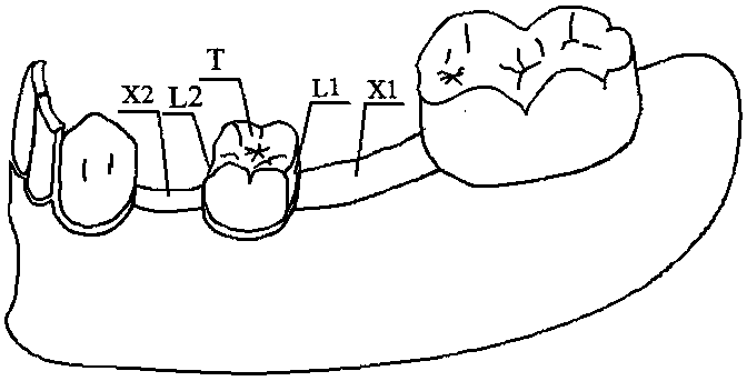 A gap restoration and maintenance device for deciduous teeth gap loss