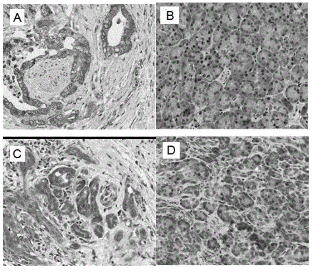 Kit for predicting pancreatic cancer patient prognosis adverse risks and application thereof