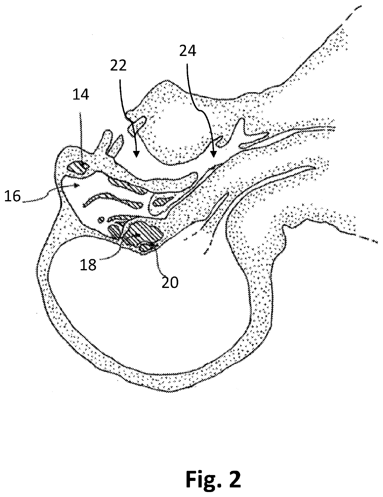 Method and apparatuses for manipulating a hypothalamus temperature set-point in humans and warm-blooded animals