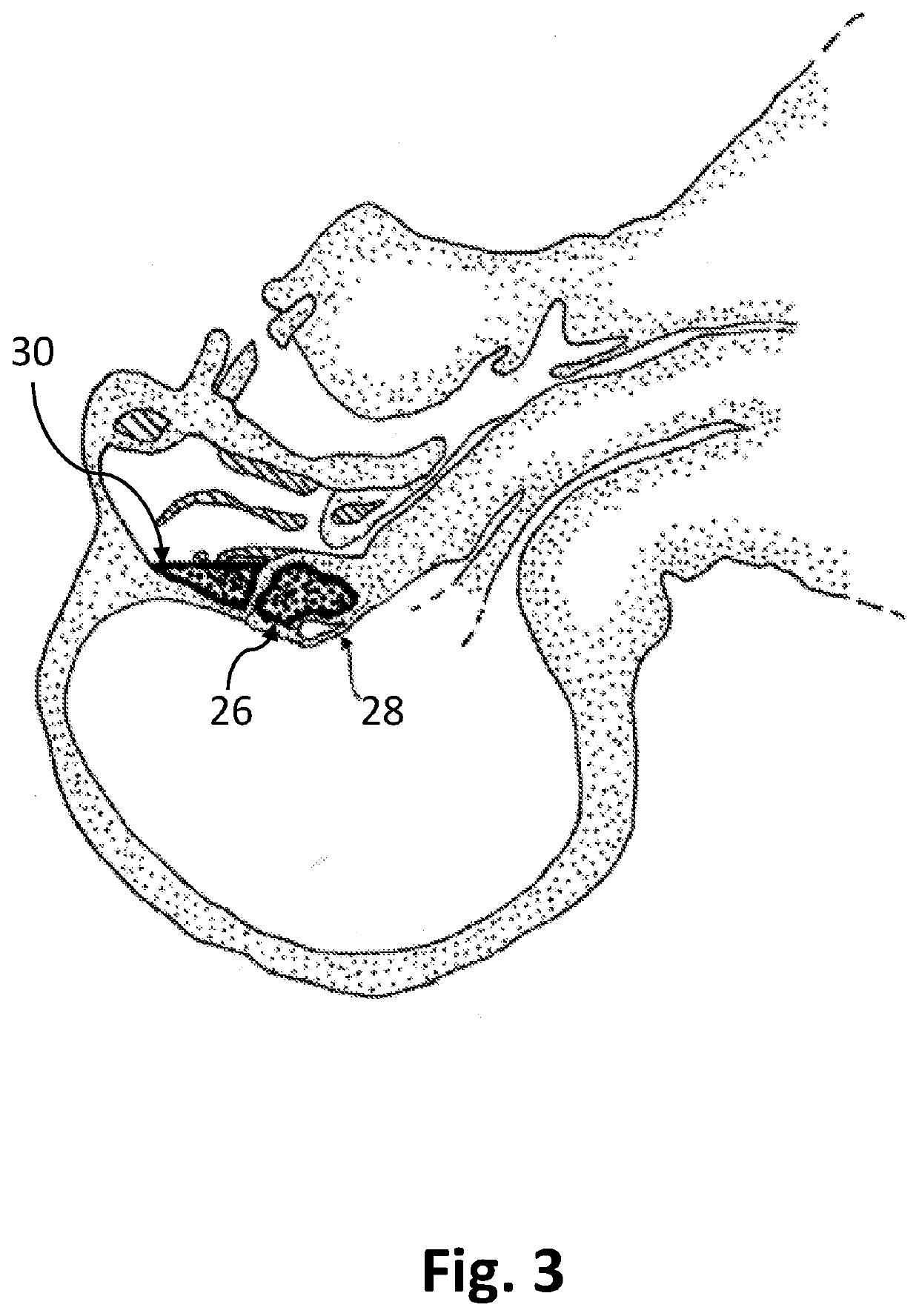 Method and apparatuses for manipulating a hypothalamus temperature set-point in humans and warm-blooded animals