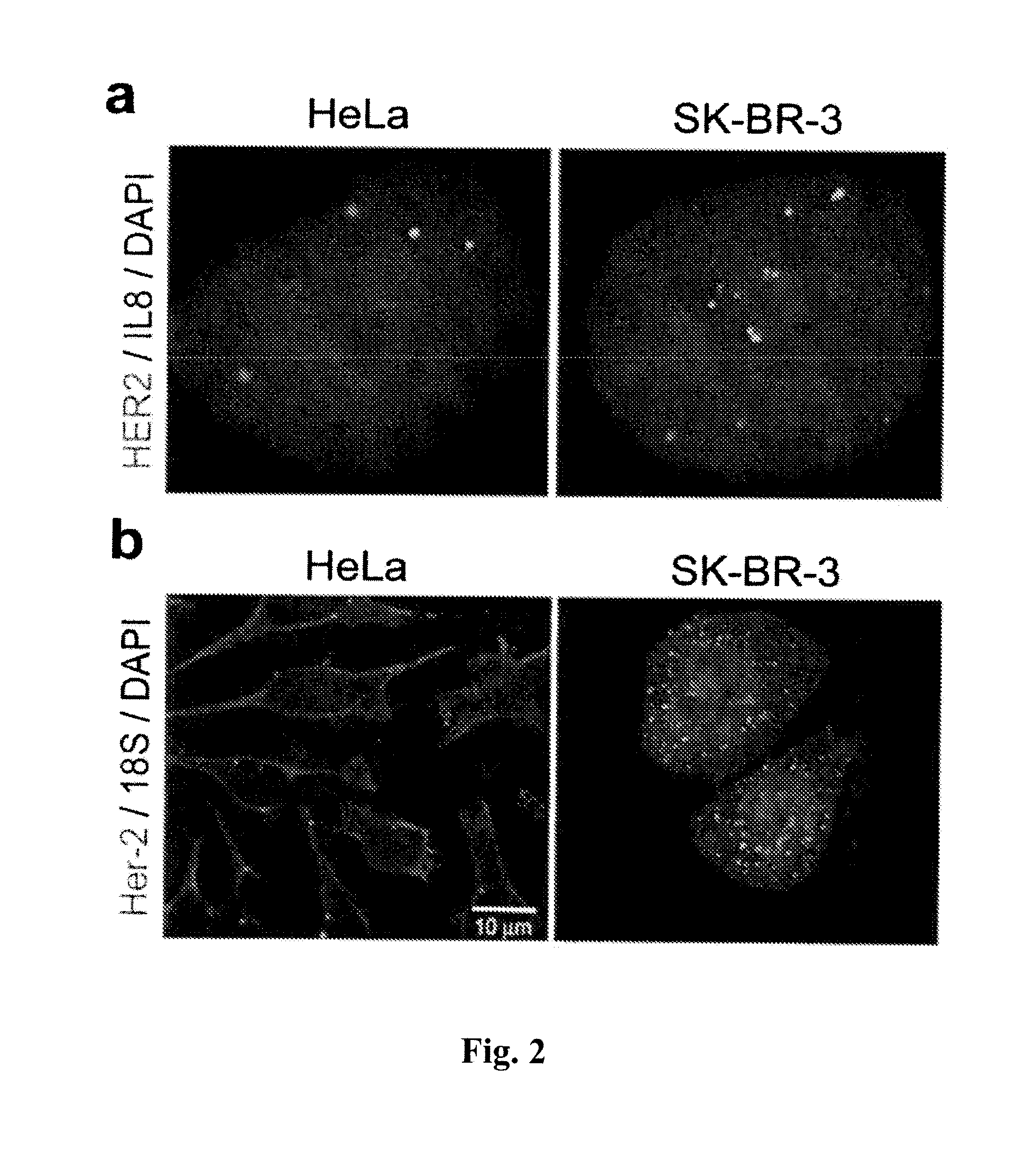 Biomarkers for differentiating melanoma from benign nevus in the skin