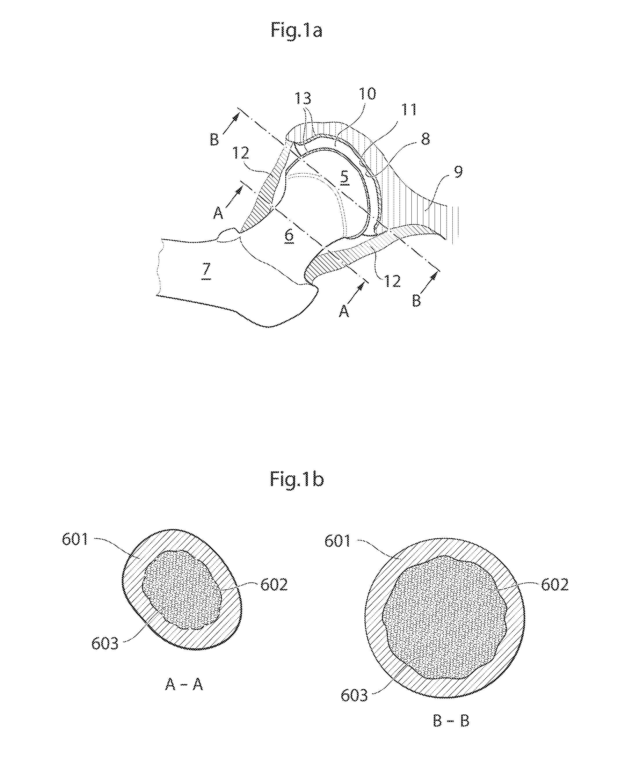 Hip joint device and method