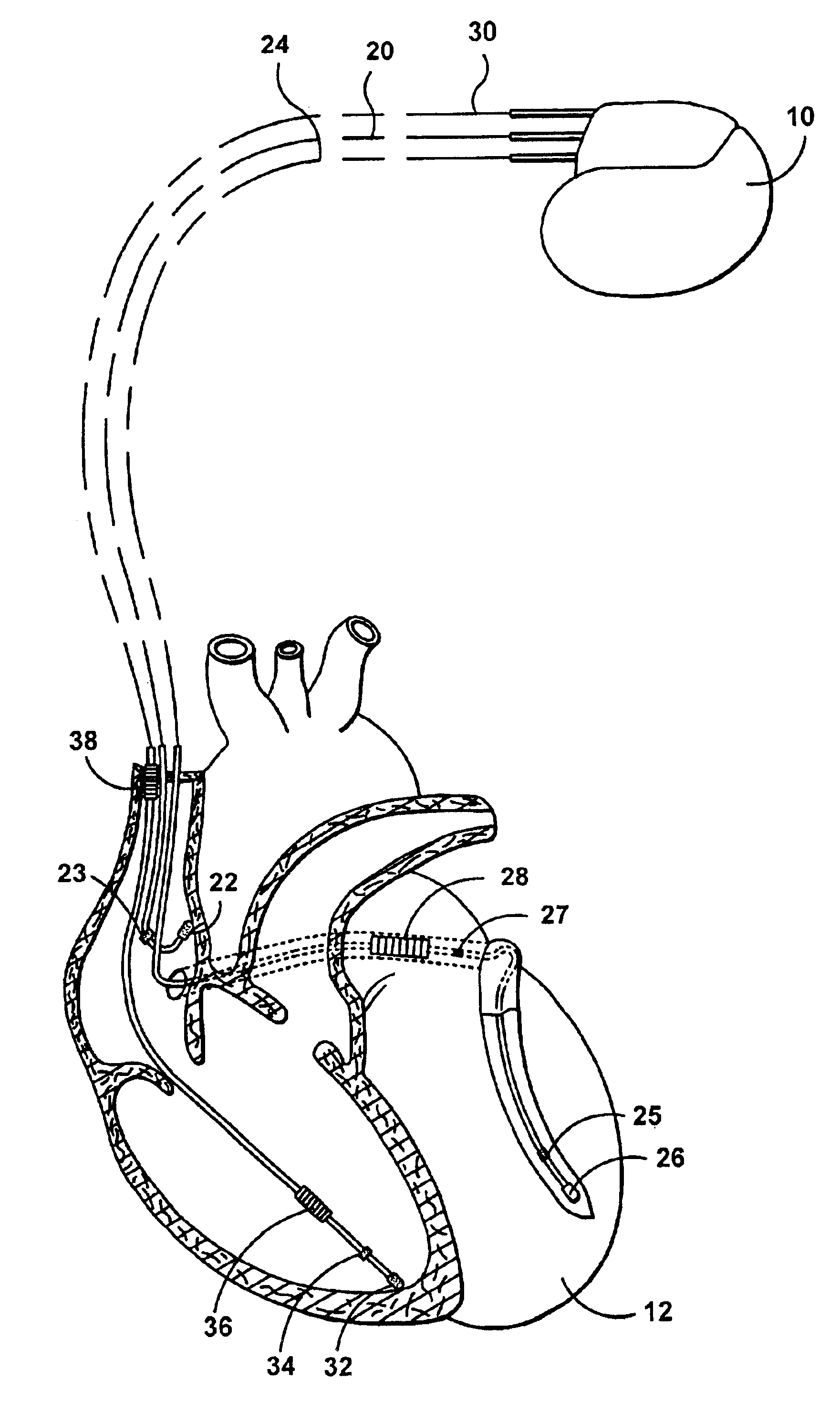 Automatic capture using independent channels in bi-chamber stimulation