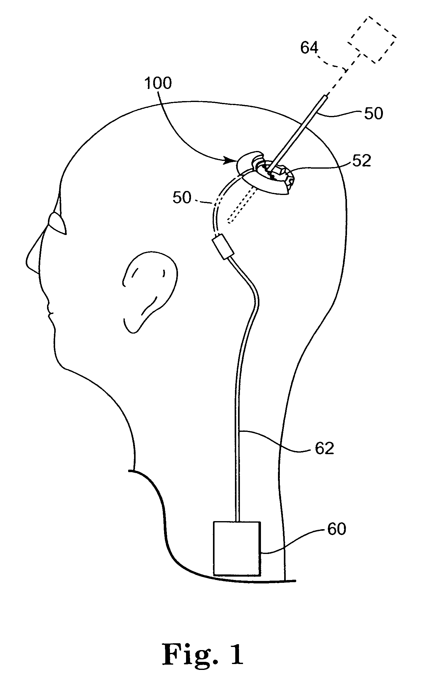 Methods and apparatus for securing a therapy delivery device within a burr hole