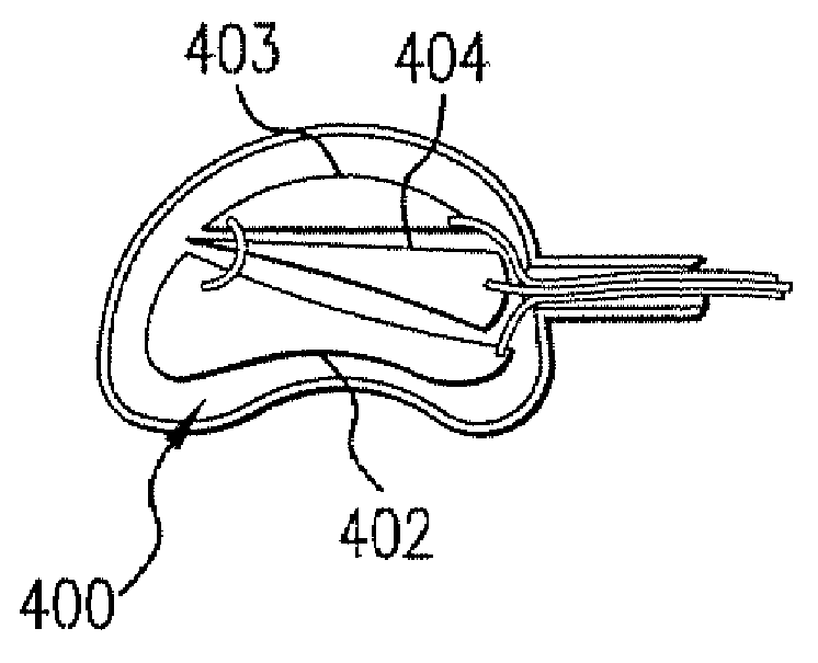 Spinal implant