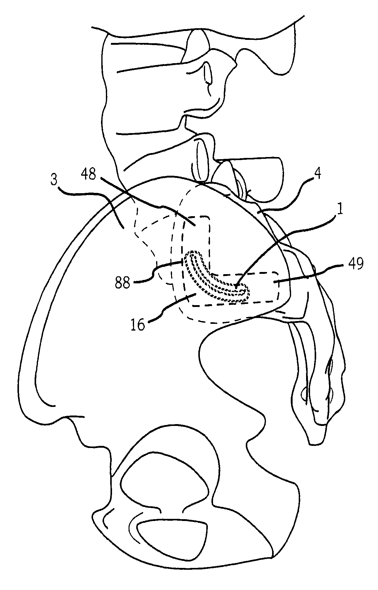 Sacroiliac joint implant system