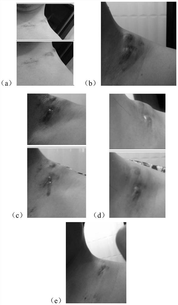 Pharmaceutical composition for treating deficiency fire and phlegm stagnation syndrome lymphatic system diseases