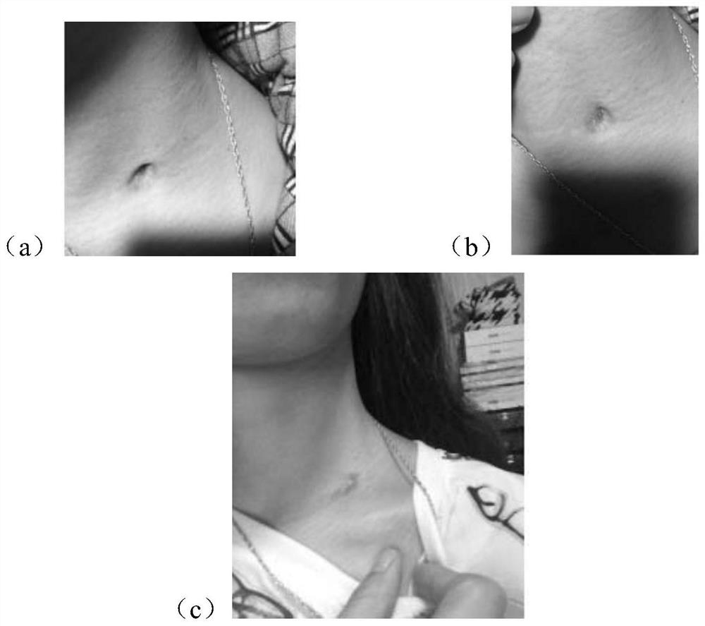 Pharmaceutical composition for treating deficiency fire and phlegm stagnation syndrome lymphatic system diseases