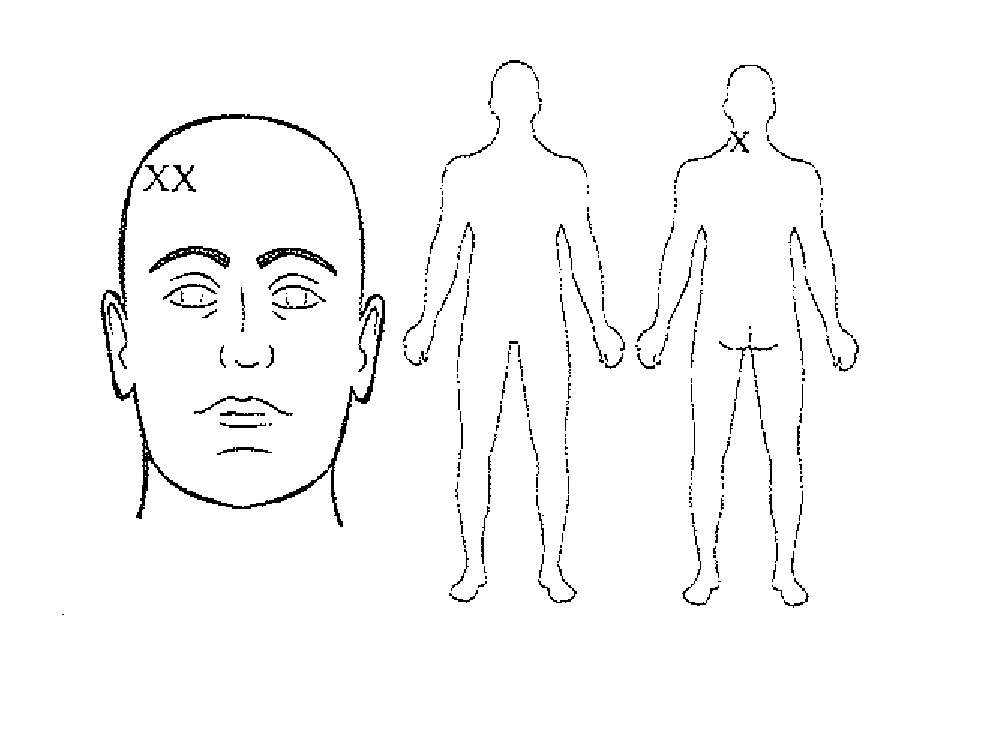 Compositions and methods for treating traumatic brain injury