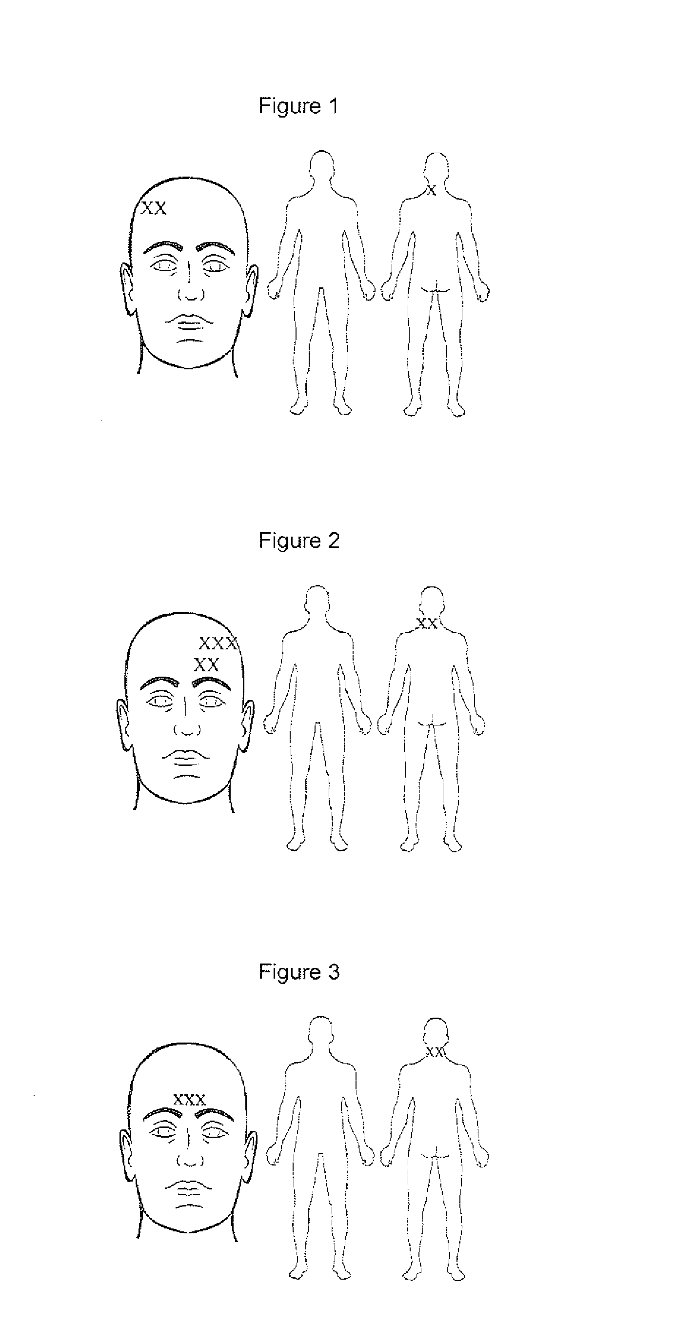 Compositions and methods for treating traumatic brain injury