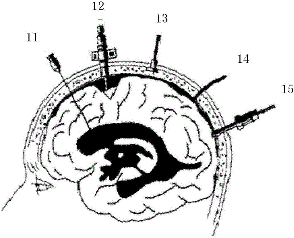 Embedded wireless passive intracranial pressure monitoring system