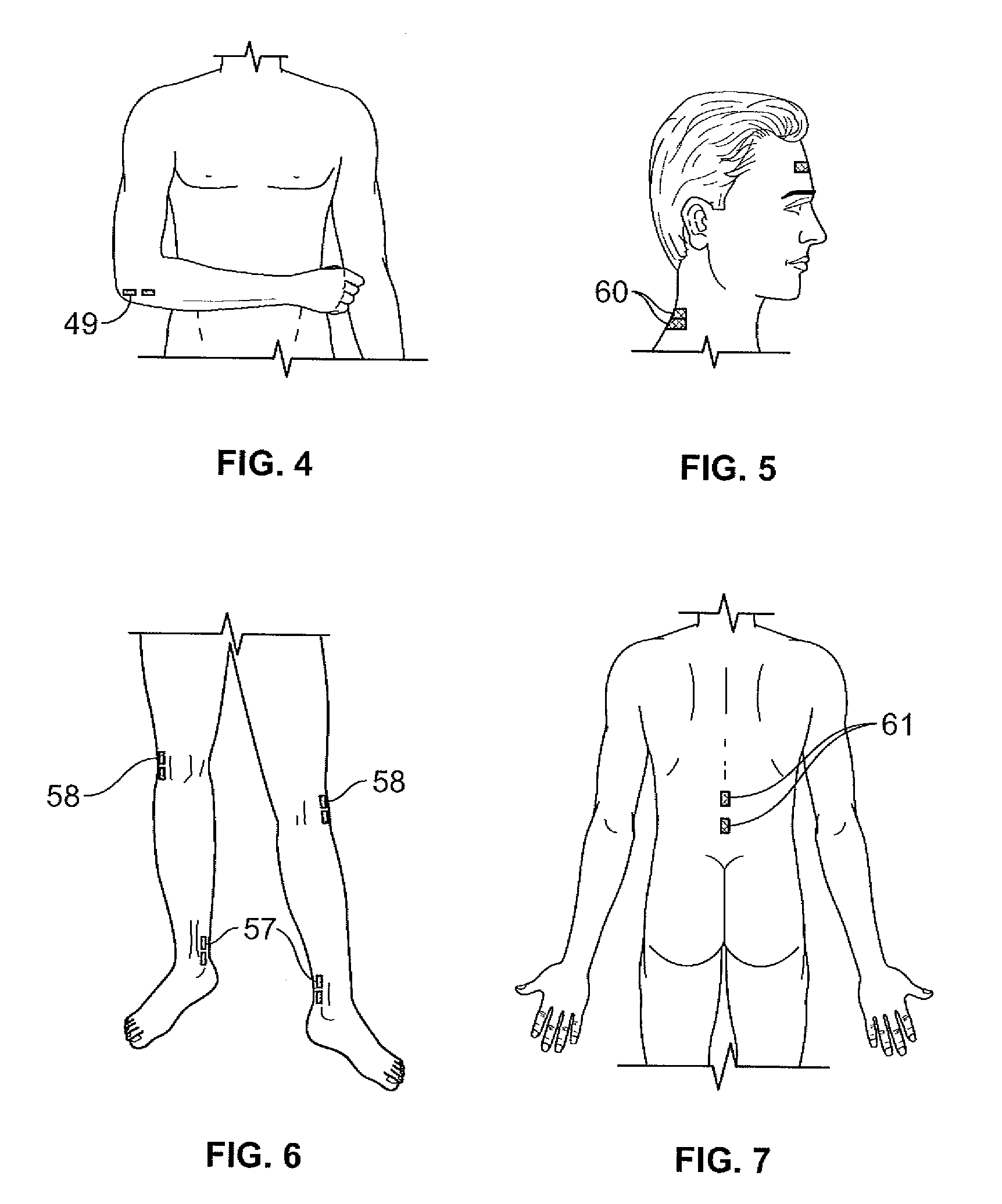 Dermatomal somatosensory evoked potential (DSSEP) apparatus for real time nerve root function diagnosis in surgical and clinical situations