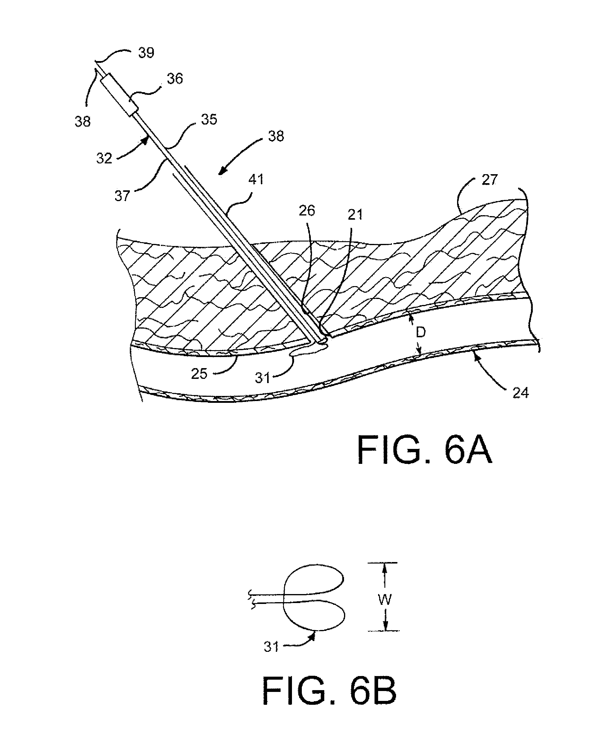 Self-Orientating Suture Wound Closure Device