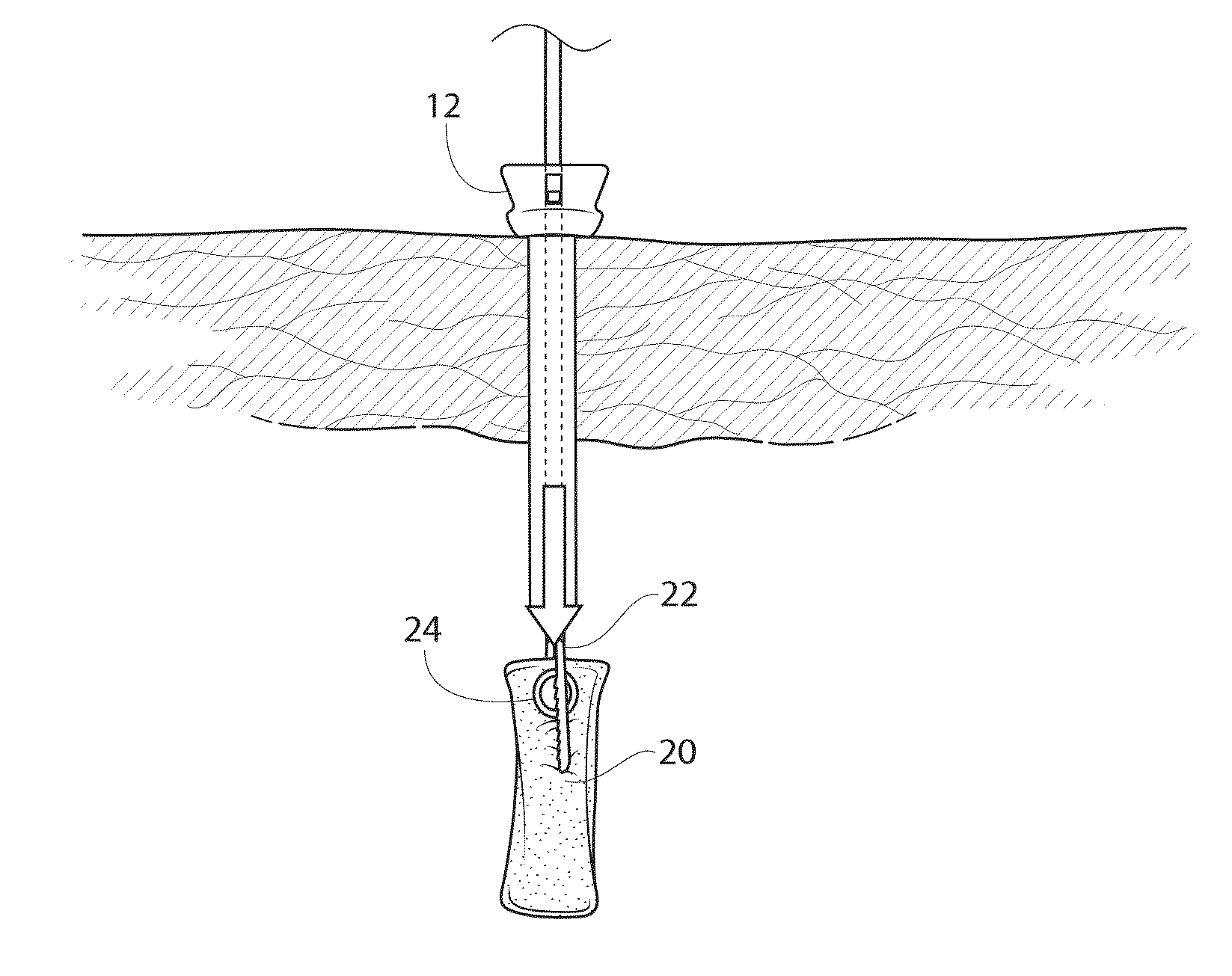 Minimally Invasive Endoscopic/Laparoscopic Highly Absorbent Surgical Devices, Methods and System