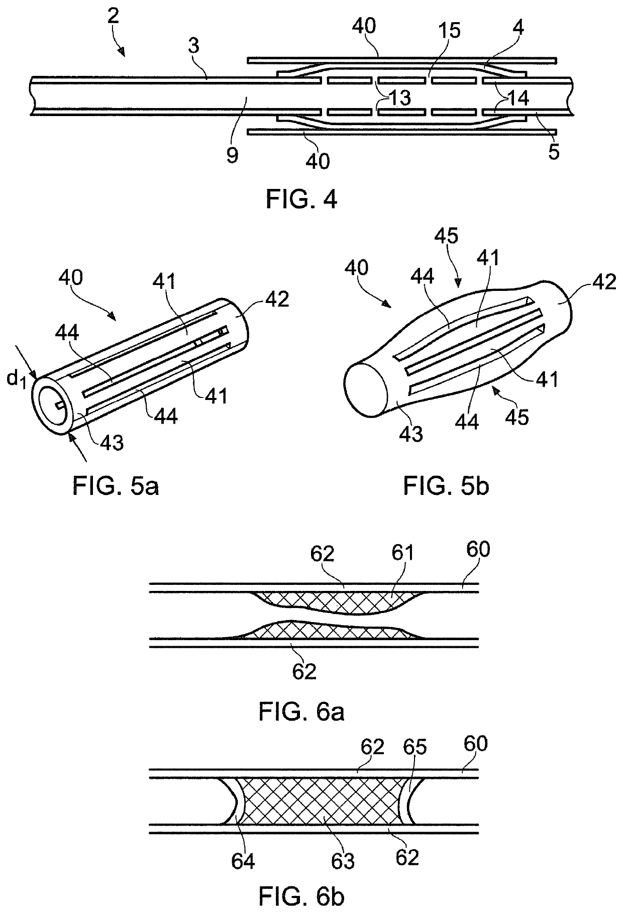 Angioplasty of calcified arteries