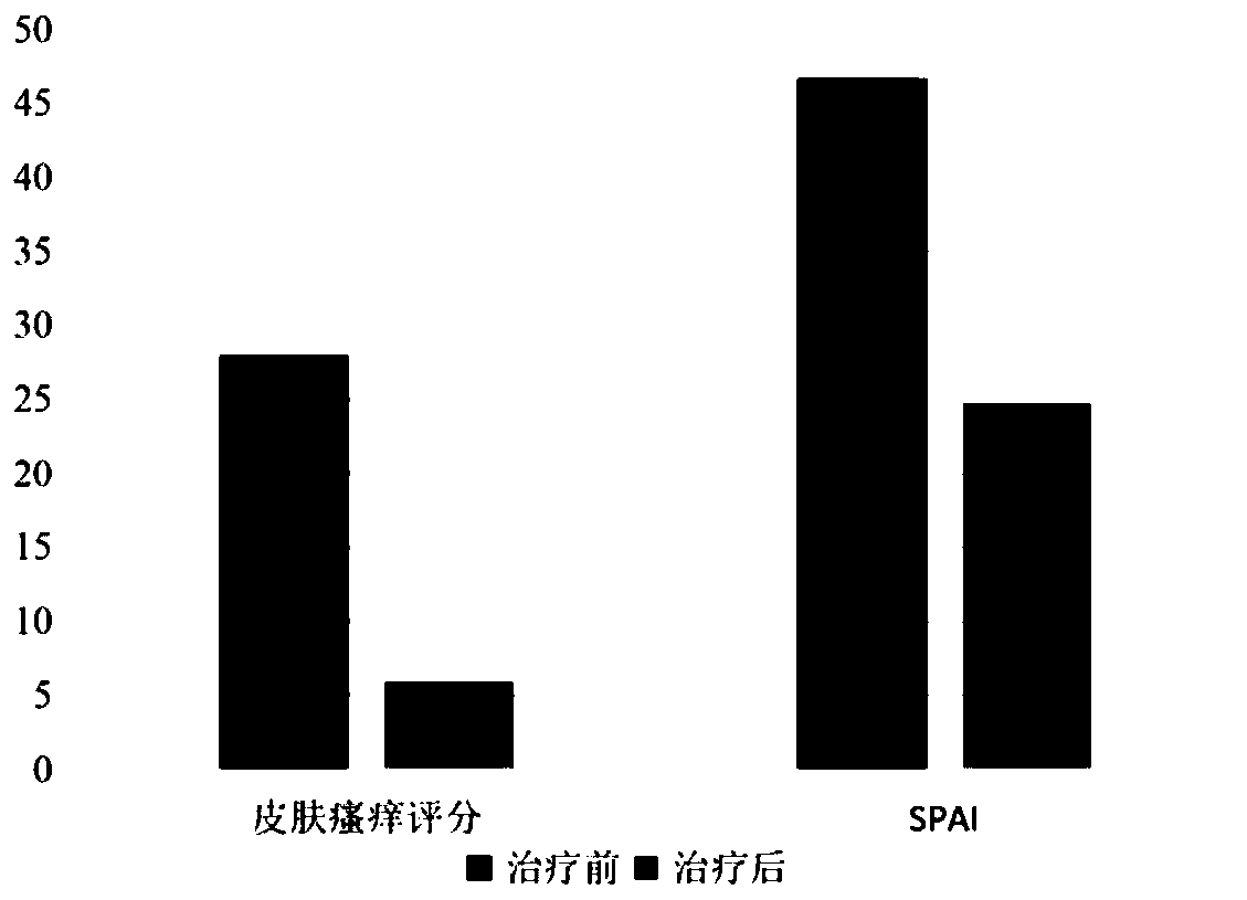 Combined drug for treating psoriasis and application of combined drug