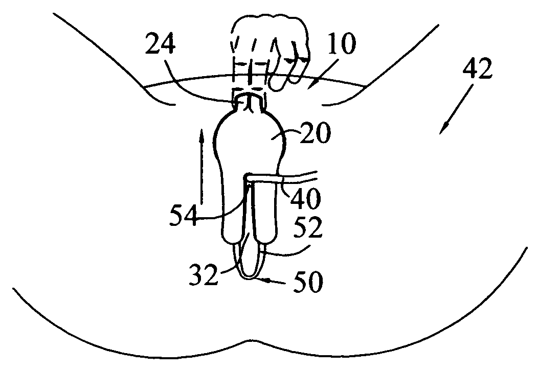 Catheterization assist device and method of use