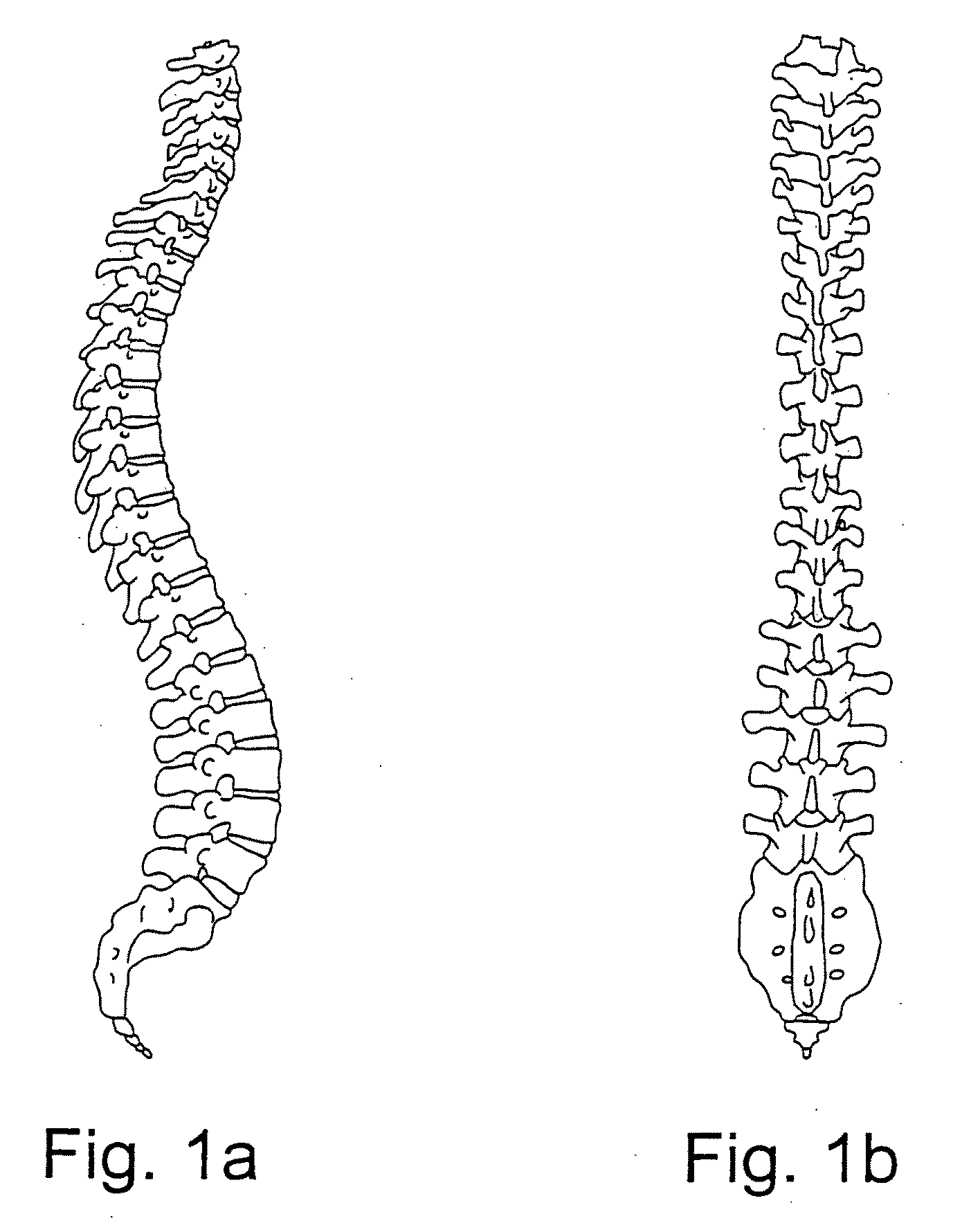 System and methods for improved access to vertebral bodies for kyphoplasty, vertebroplasty, vertebral body biopsy or screw placement