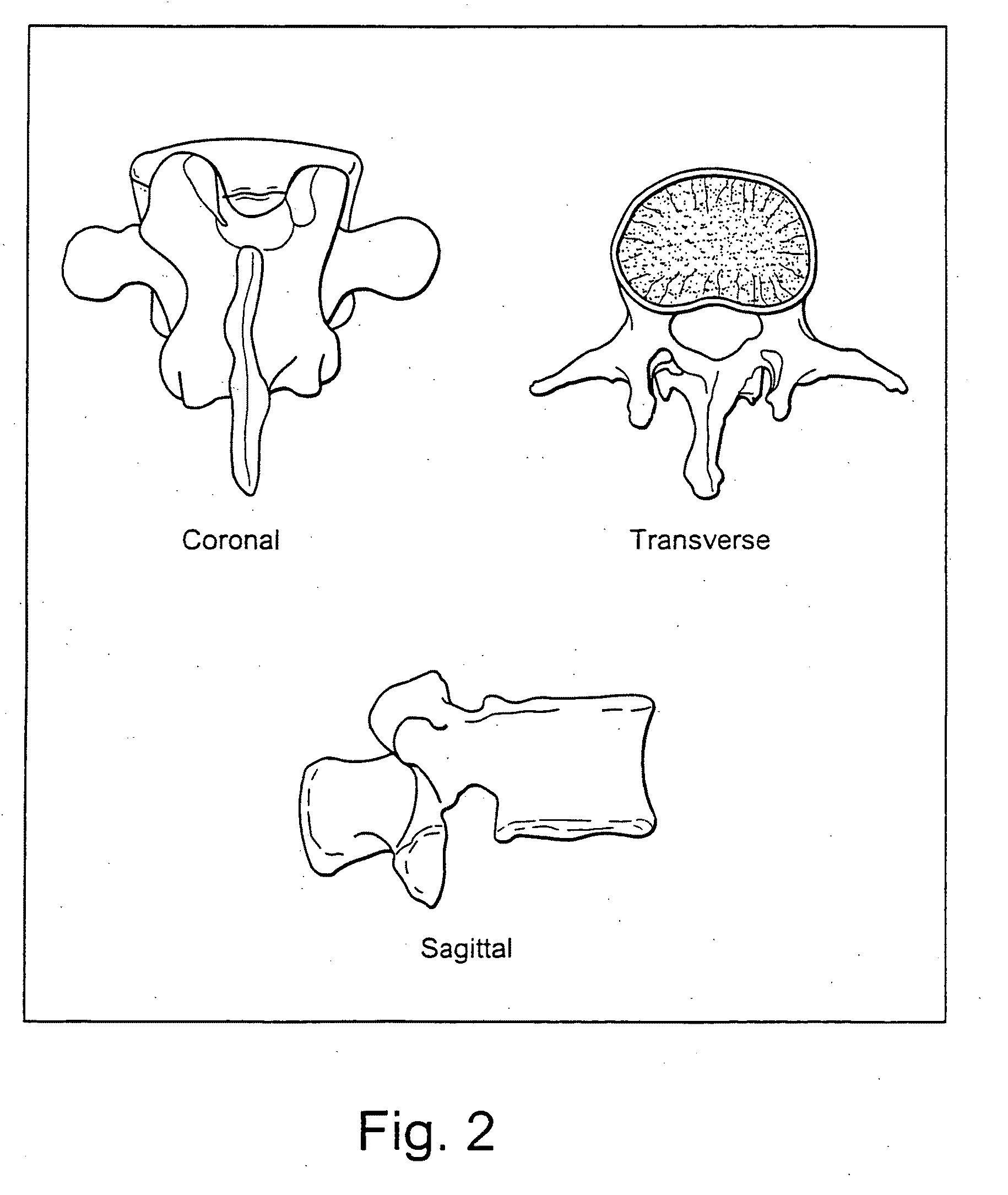 System and methods for improved access to vertebral bodies for kyphoplasty, vertebroplasty, vertebral body biopsy or screw placement