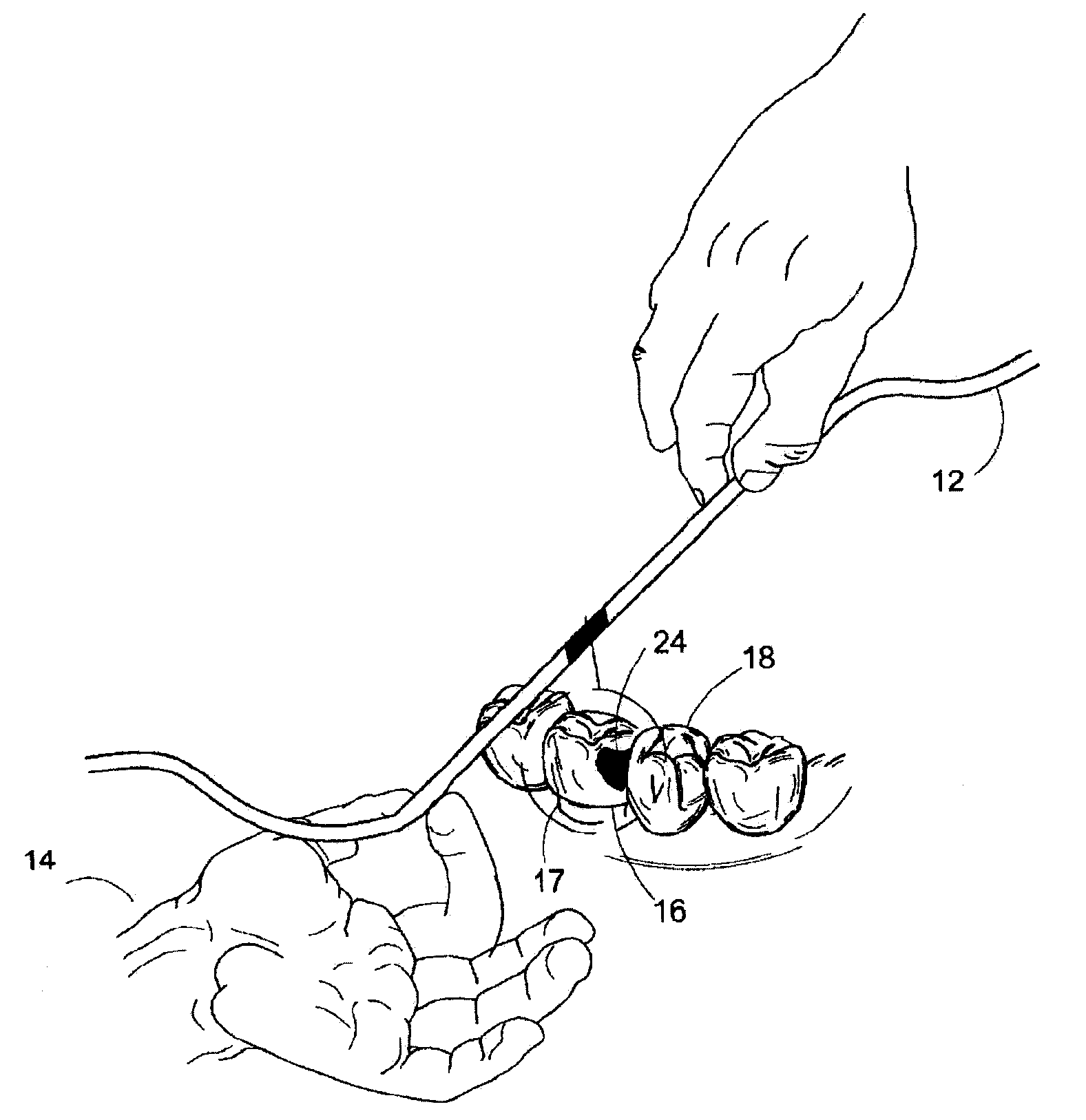 Method for seating a dental restoration