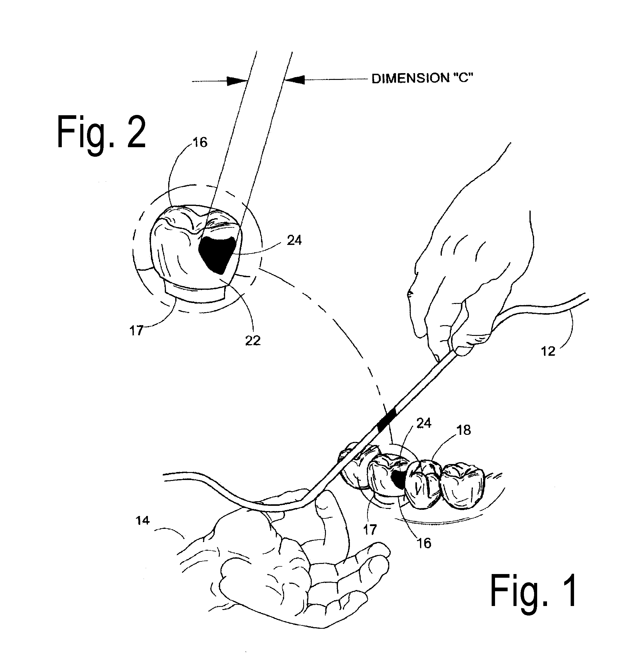 Method for seating a dental restoration