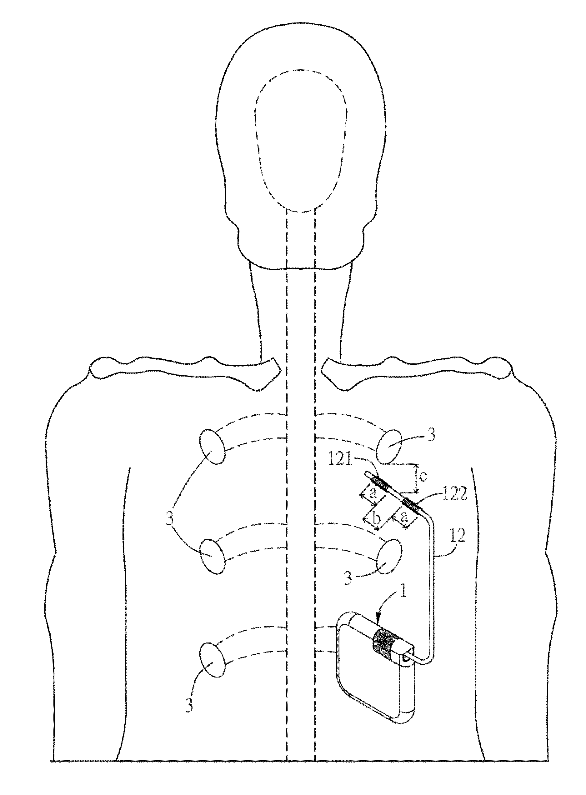 Electronic stimulation system and device thereof for  dorsal root ganglion