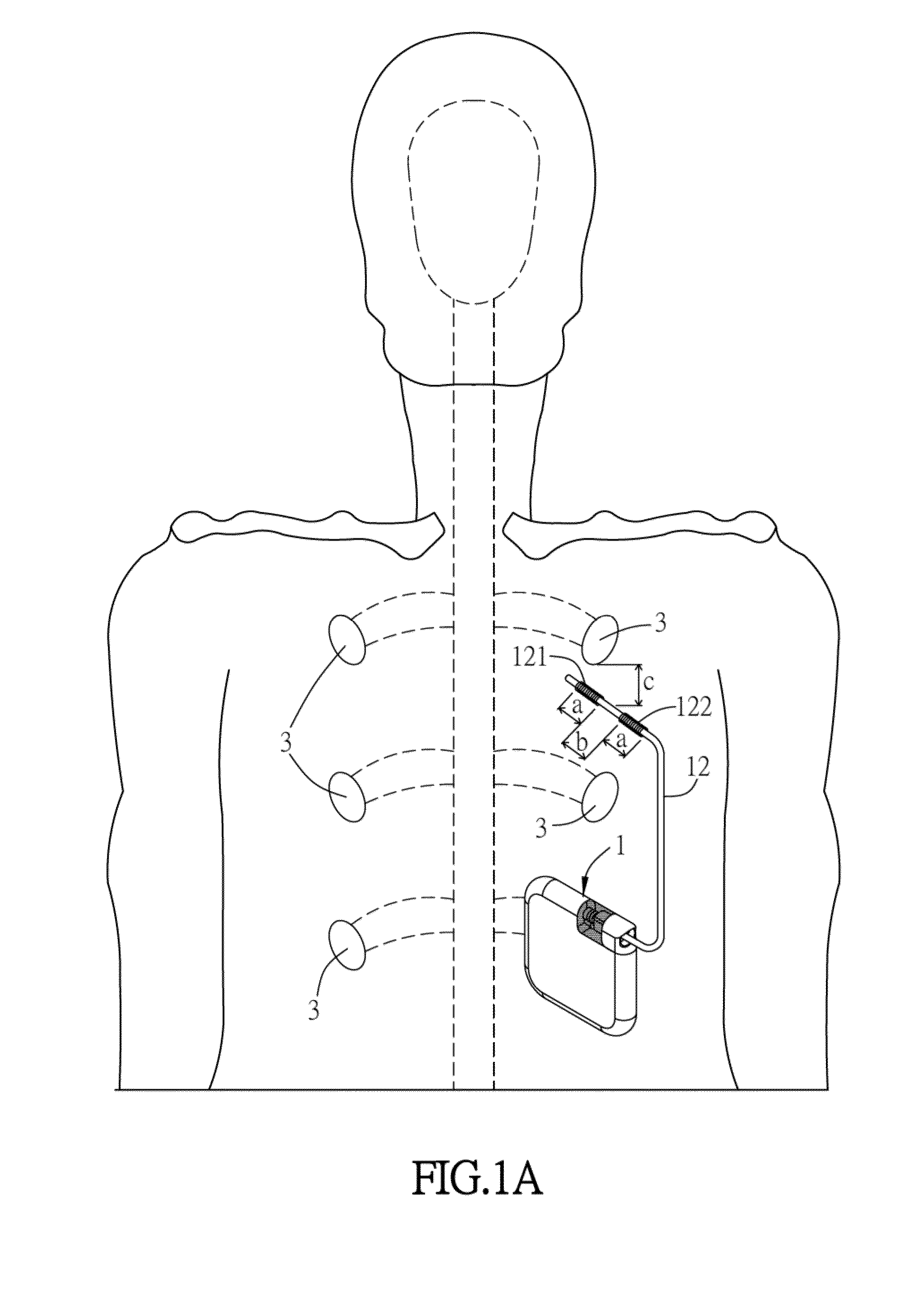 Electronic stimulation system and device thereof for  dorsal root ganglion