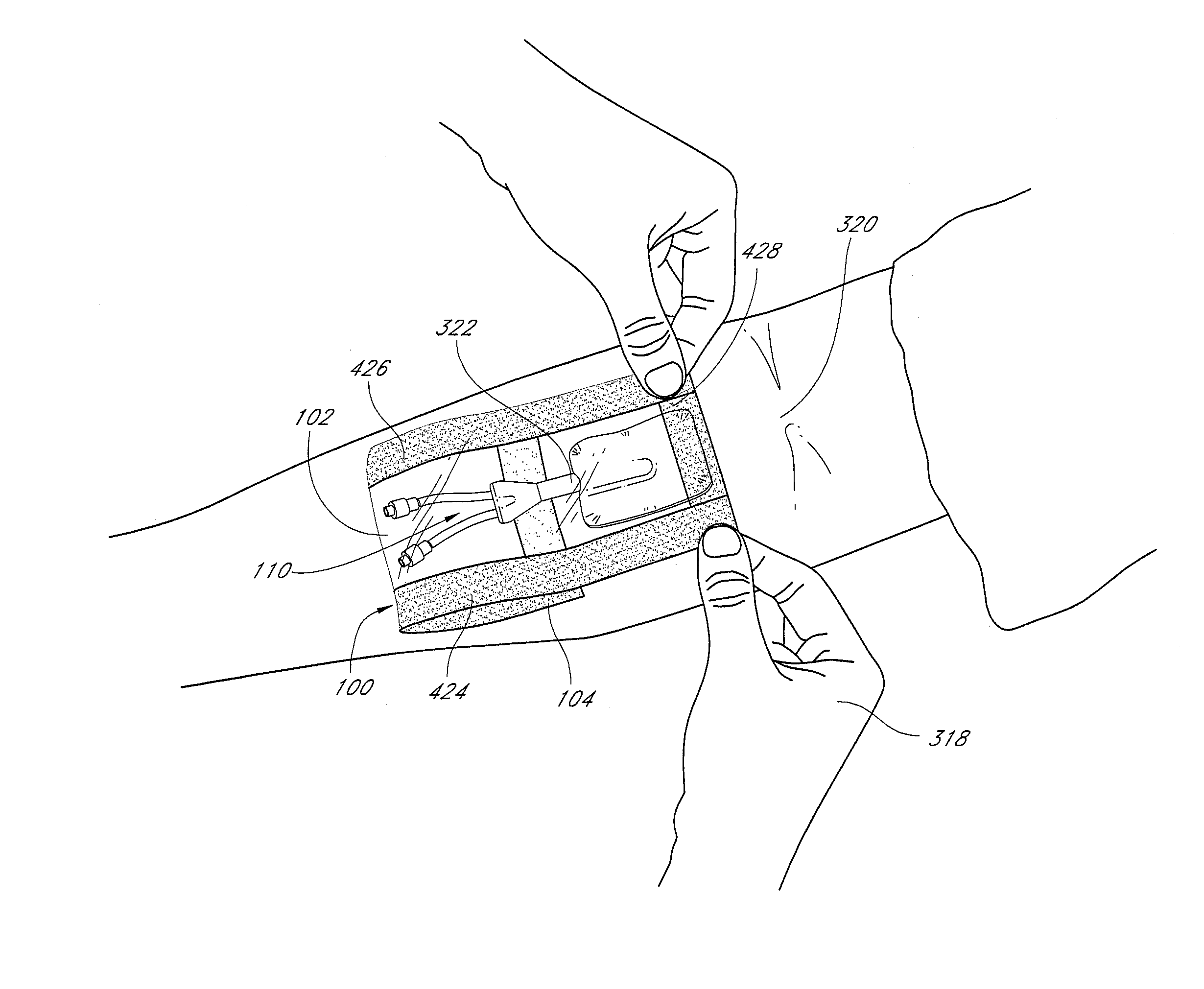 Flexible and leakproof and leak-resistant medical barriers and systems and methods of use thereof