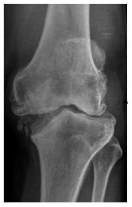 A knee joint defect pad and its manufacturing method