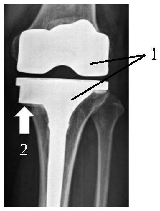 A knee joint defect pad and its manufacturing method