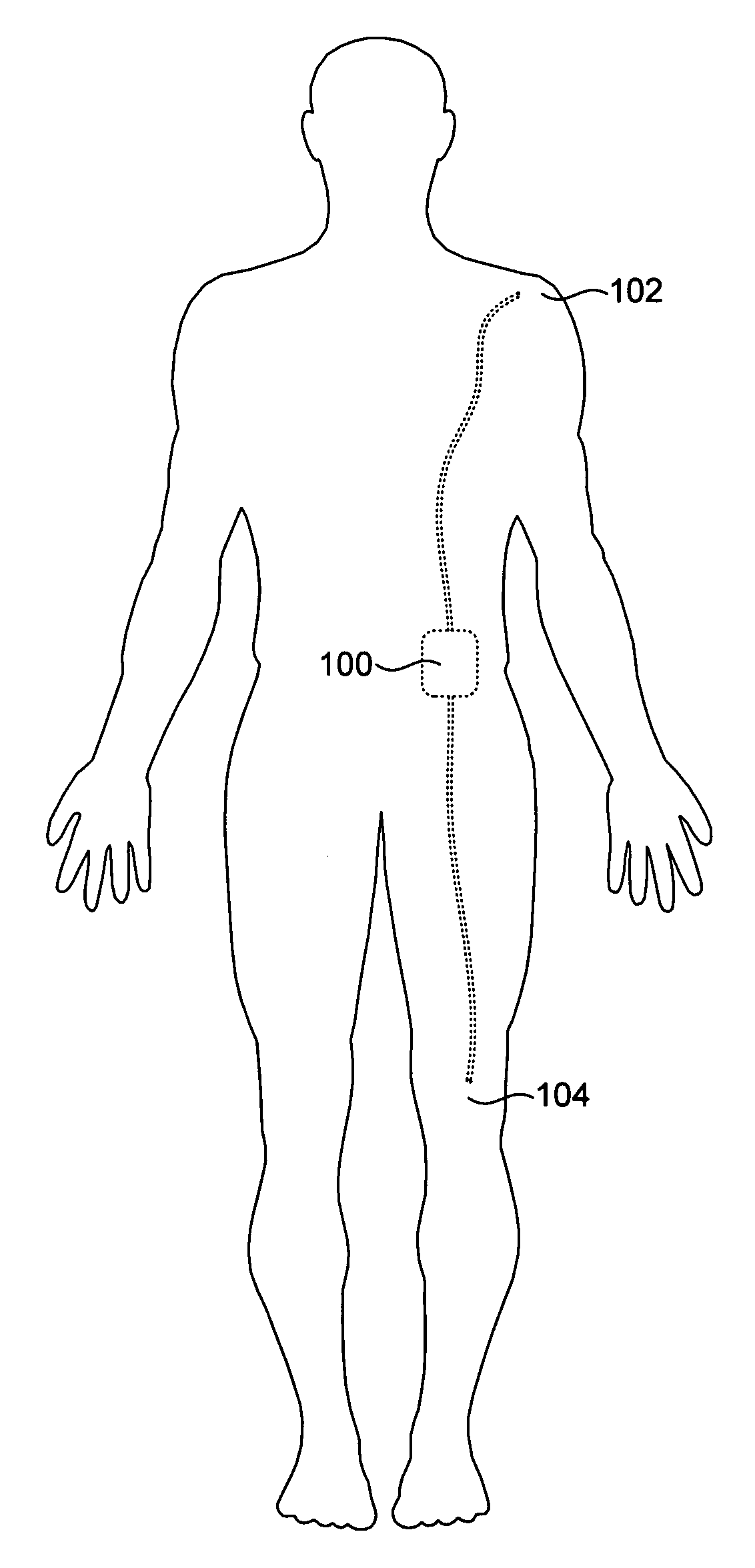 Fluid Delivery Device With Flow Rate Control