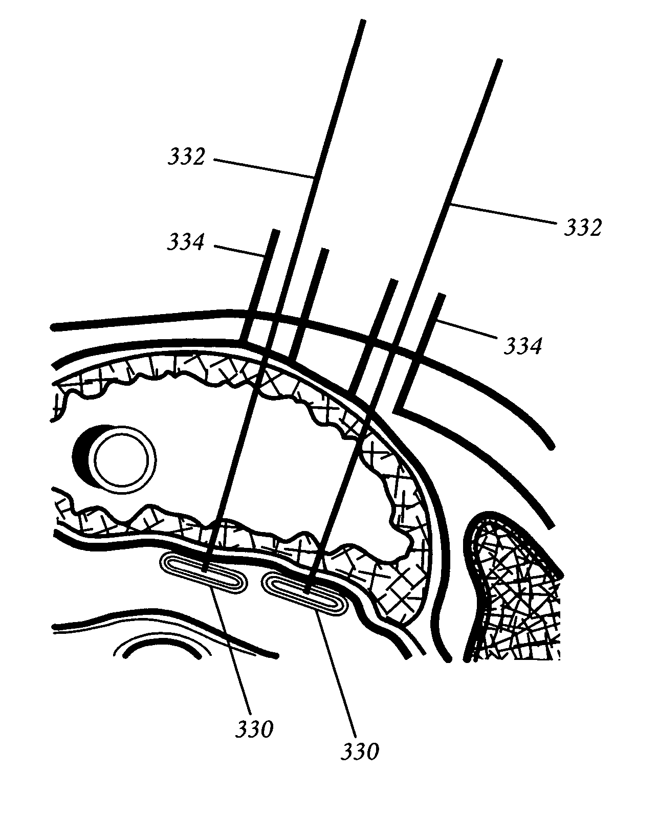 Percutaneous gastroplasty