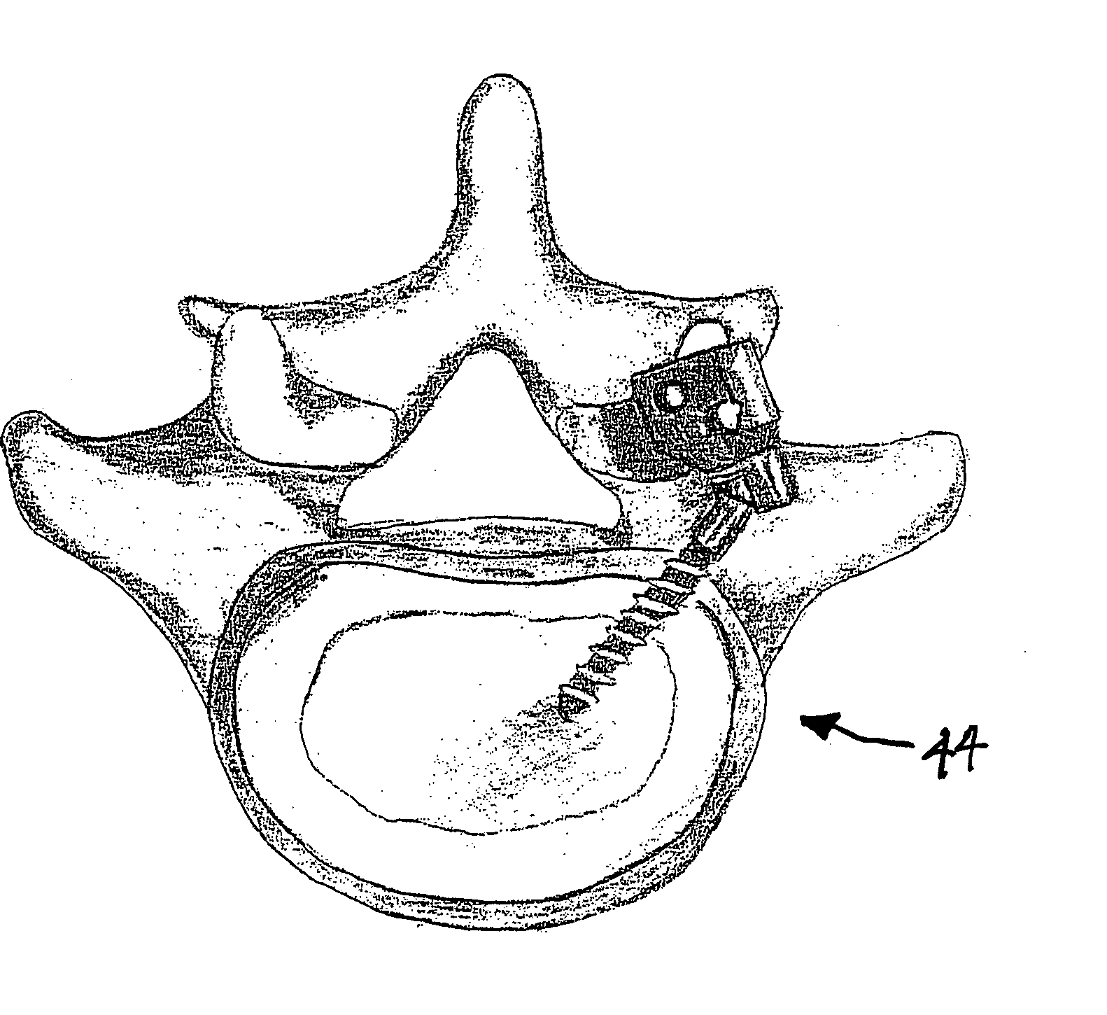 Facet joint prosthesis and method of replacing a facet joint