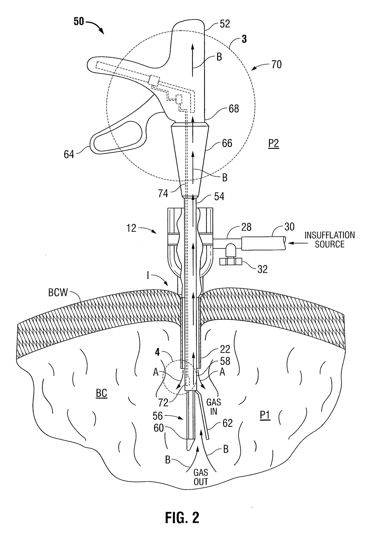 Internally pressurized medical devices