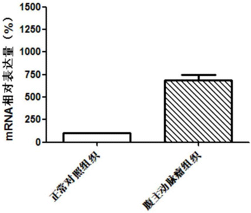 Diagnostic marker for abdominal aortic aneurysm