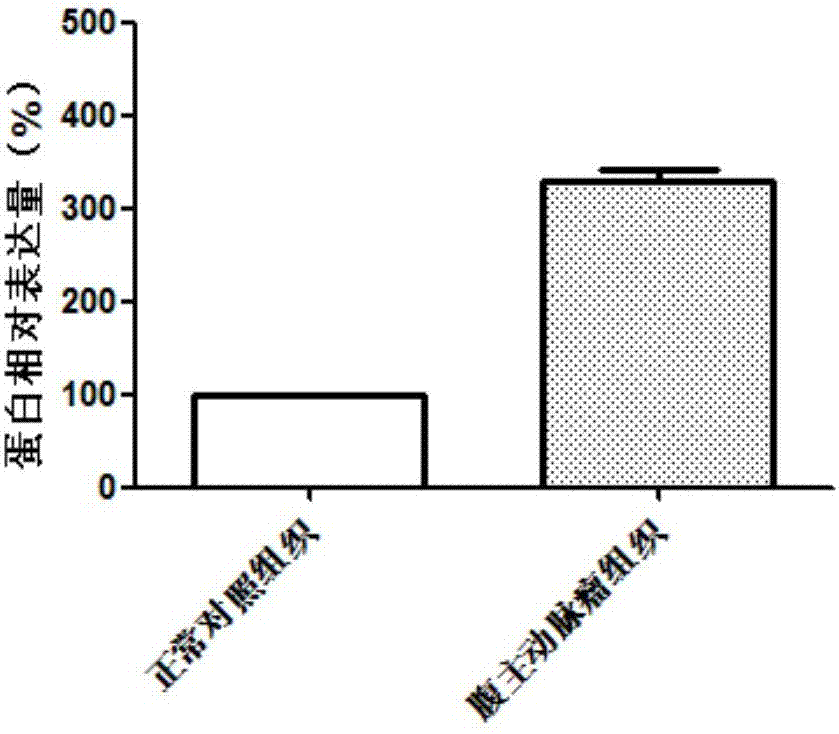 Diagnostic marker for abdominal aortic aneurysm