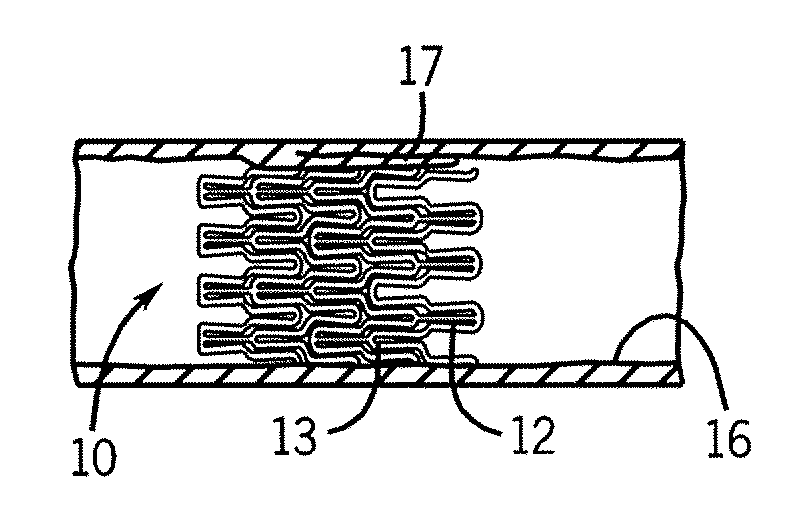 Stent designs for use in peripheral vessels