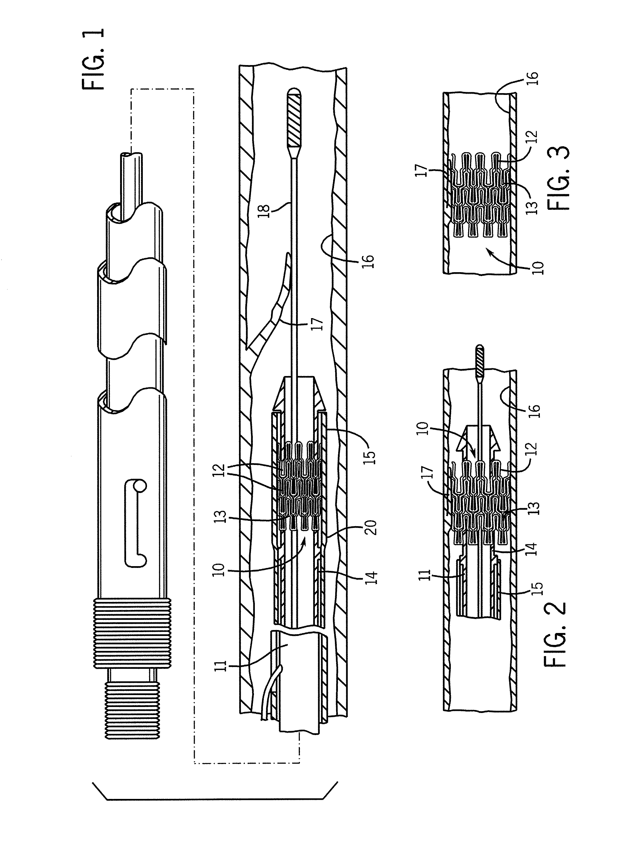 Stent designs for use in peripheral vessels