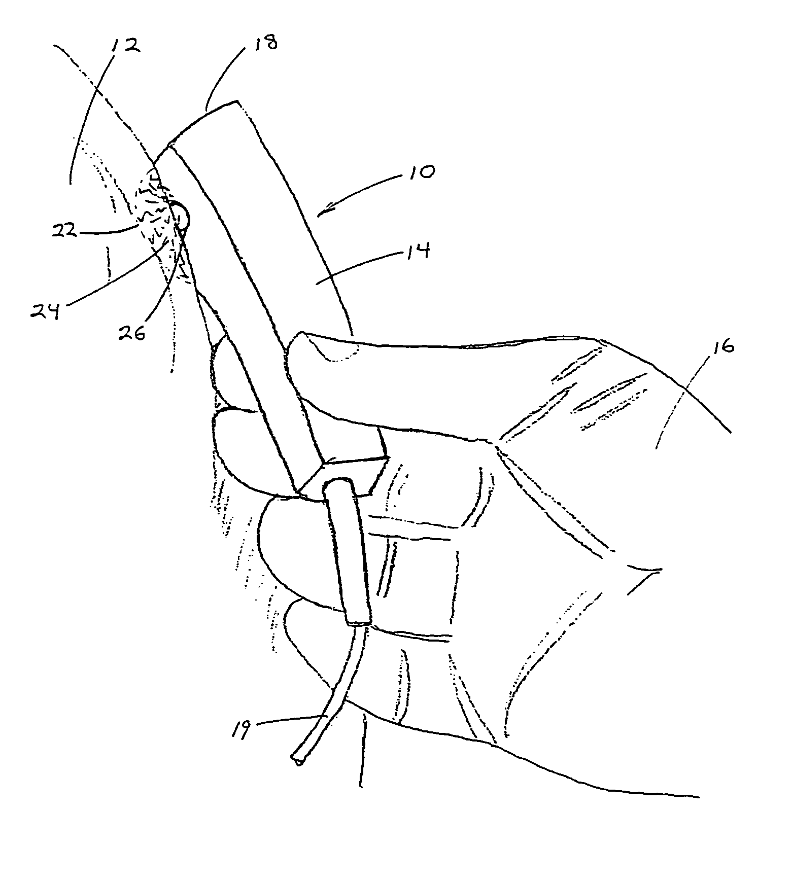 Method and apparatus for pulsed electromagnetic therapy