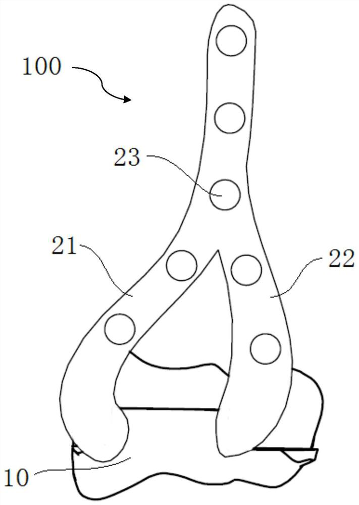 Superficial replacement prosthesis for elbow joint