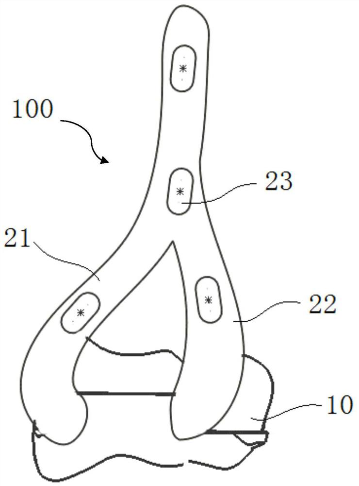 Superficial replacement prosthesis for elbow joint