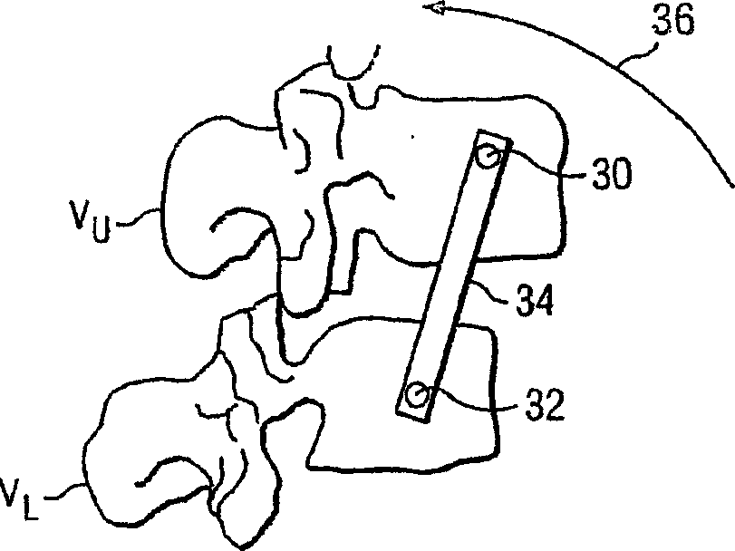 Articular disc prosthesis for anterior-oblique insertion