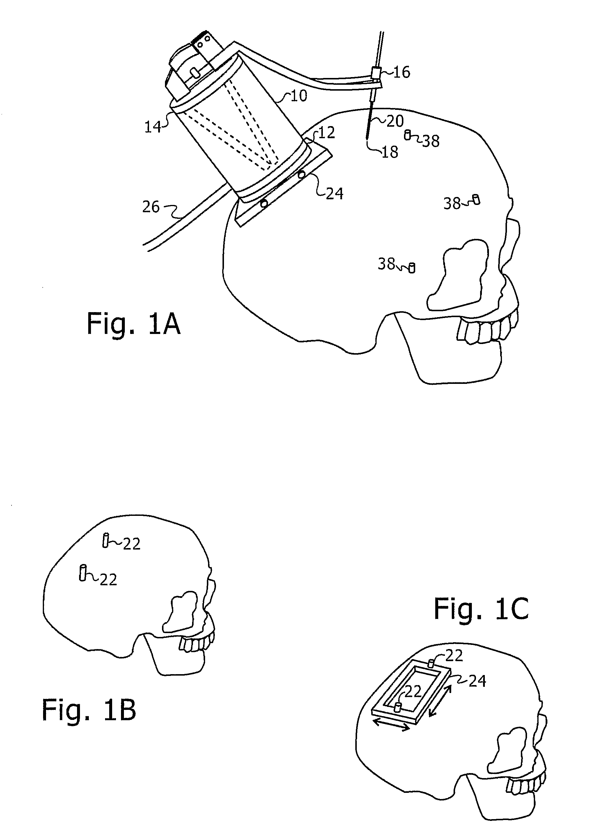 Image guided robotic system for keyhole neurosurgery