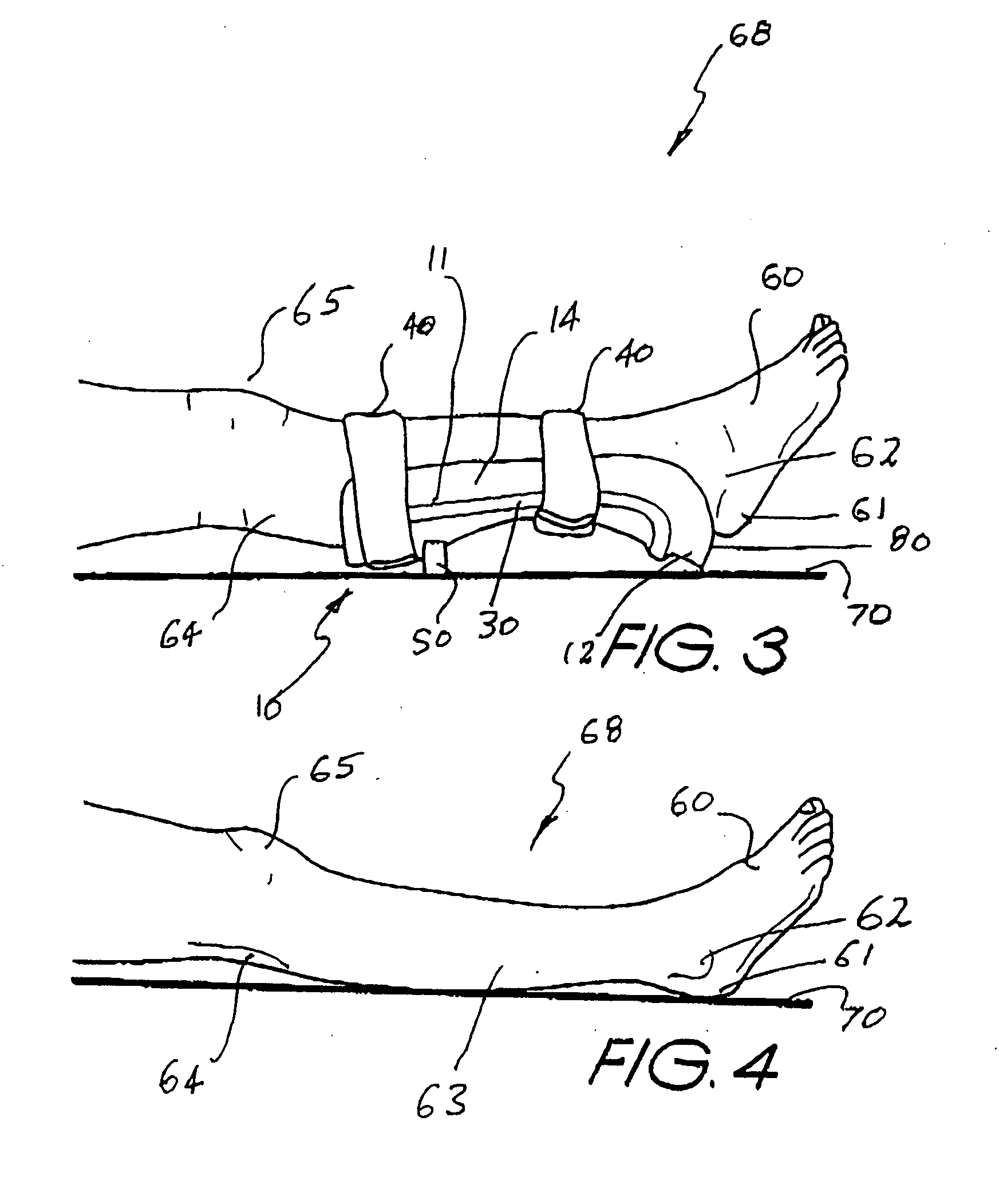 Pressure ulcer prosthesis and method for treating and/or preventing pressure ulcers